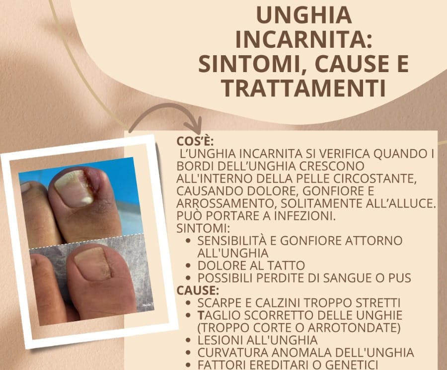 UNGHIA-INCARNITA-PROTESI
